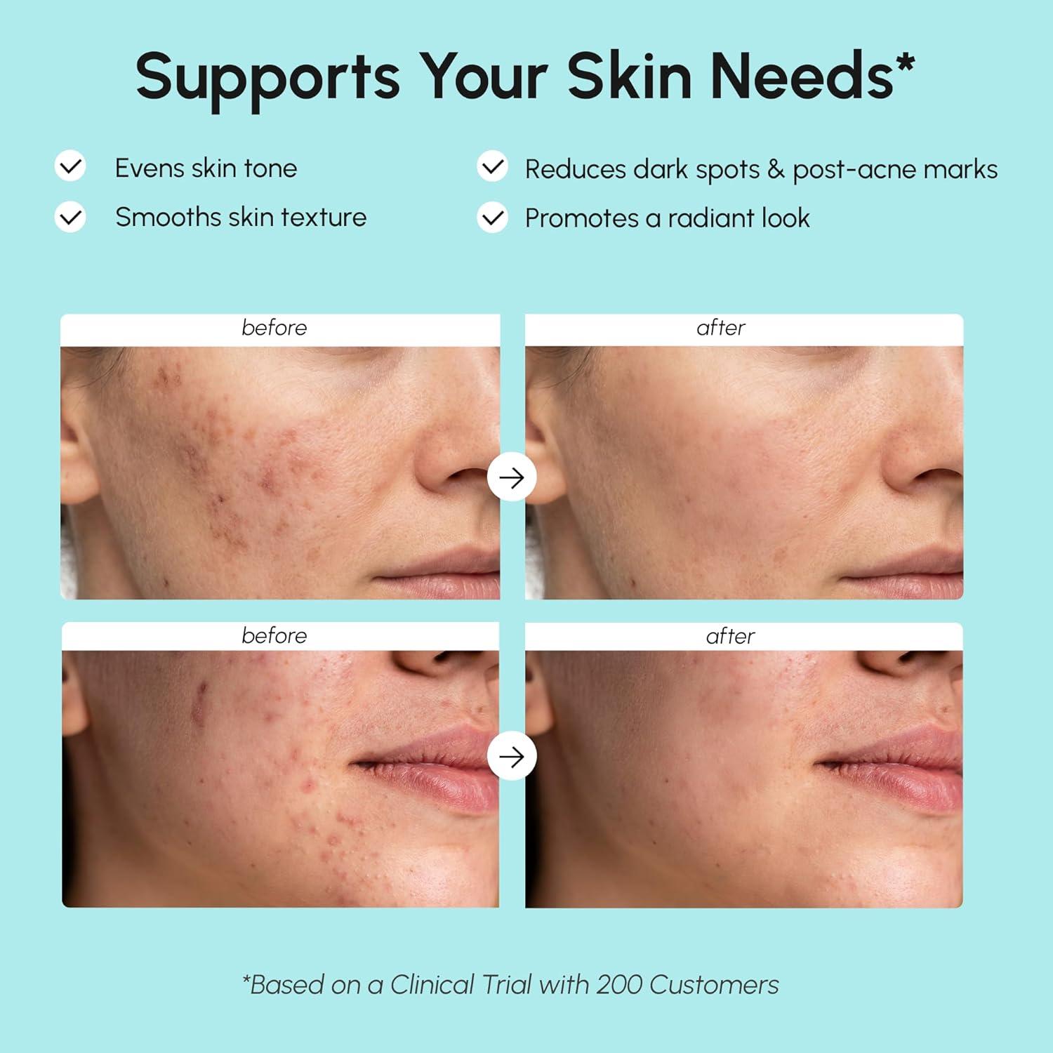 MAREE Azelaic Acid 15% Face Cream – Azelaic Acid Treatment with Niacinamide & Salicylic Acid – Dark Spot Corrector for Face, Redness Relief, Smooth Even Skin Tone – Acido Azelaico for Acne Prone Skin(1 Fl Oz (Pack of 1))