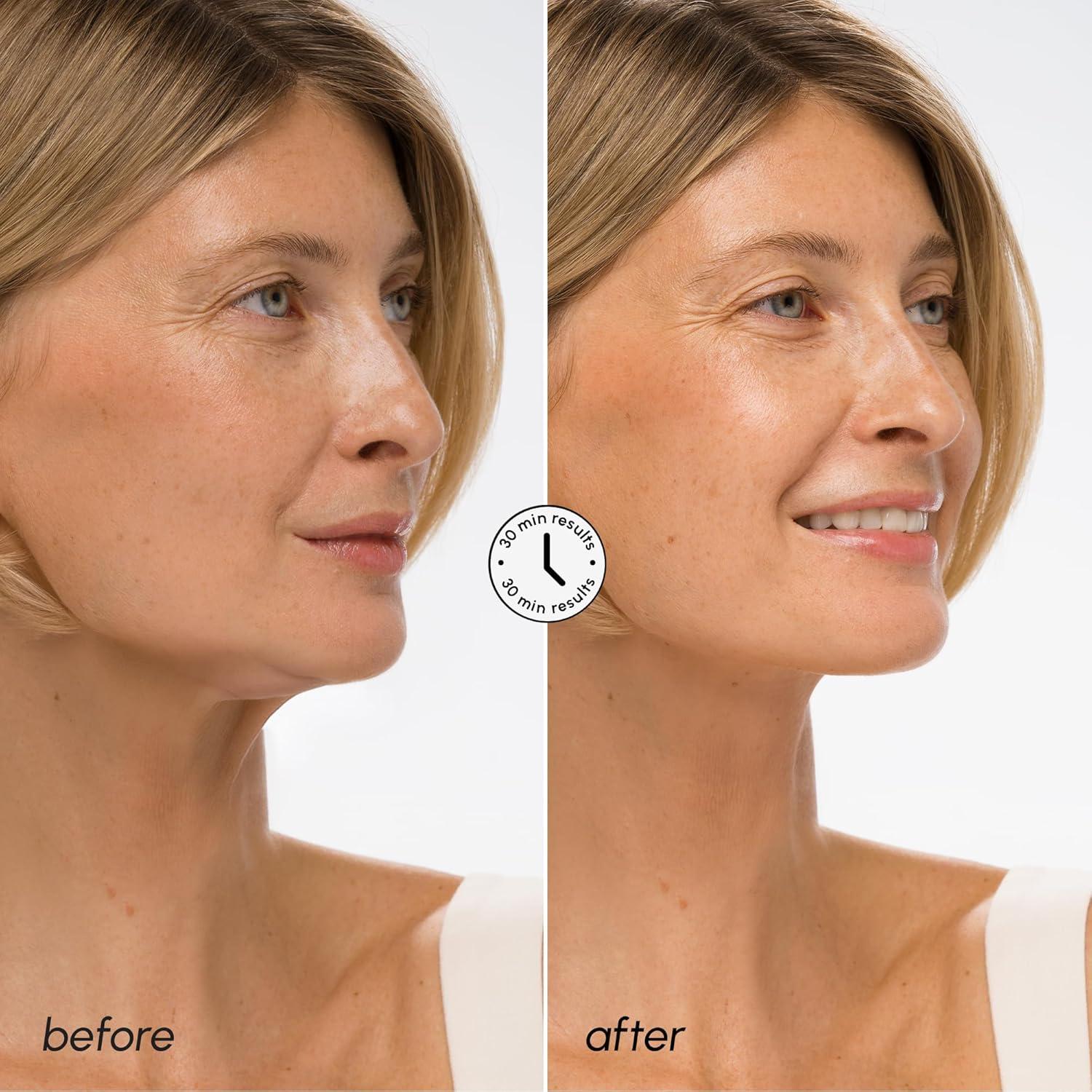 MAREE V Line Lifting Mask with 24K Gold – Deep Collagen Face Mask for Women – Jawline Shaper Mask with Retinol & Hyaluronic Acid – Neck Tightening & Firming – Double Chin Strap for Face Lift(Hyaluronic Acid)