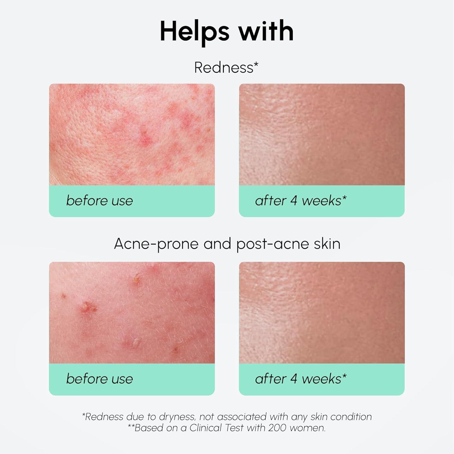 MAREE 20% Tranexamic Acid Serum Complex with Niacinamide & Vitamin C – Serum for Face & Body Dark Spot Corrector – Age Spots Hyperpigmentation Care Remover – Brightening Acido Tranexamico para Manchas(Azelaic Acid Face Serum)