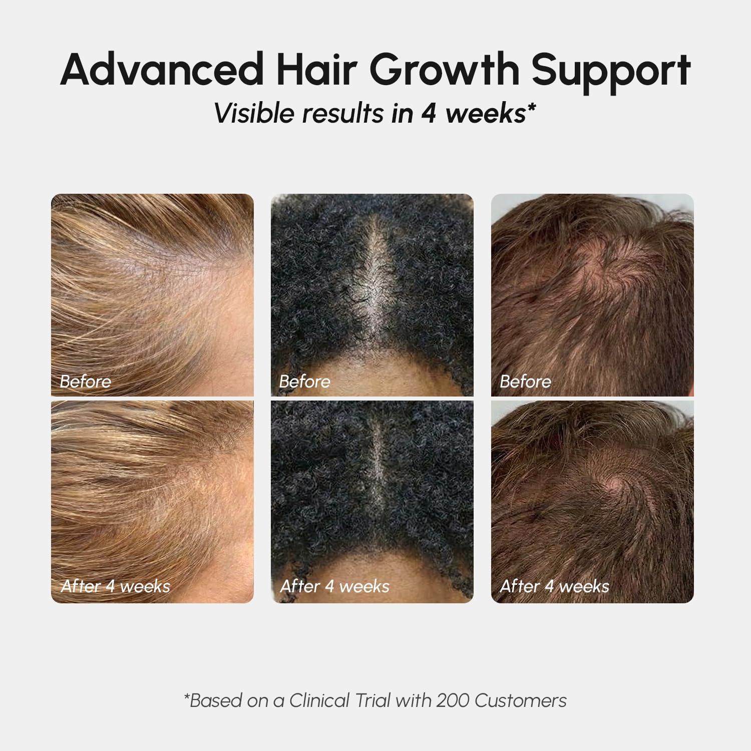 MAREE Hair Growth Spray – Caffeine, Batana, Castor & Rosemary Oil for Hair Growth – Products for Women & Men – Hair Oils for Hair Growth – Hair Thickening Spray for Roots – Hair Regrowth & Scalp Care(Hair Growth Spray)
