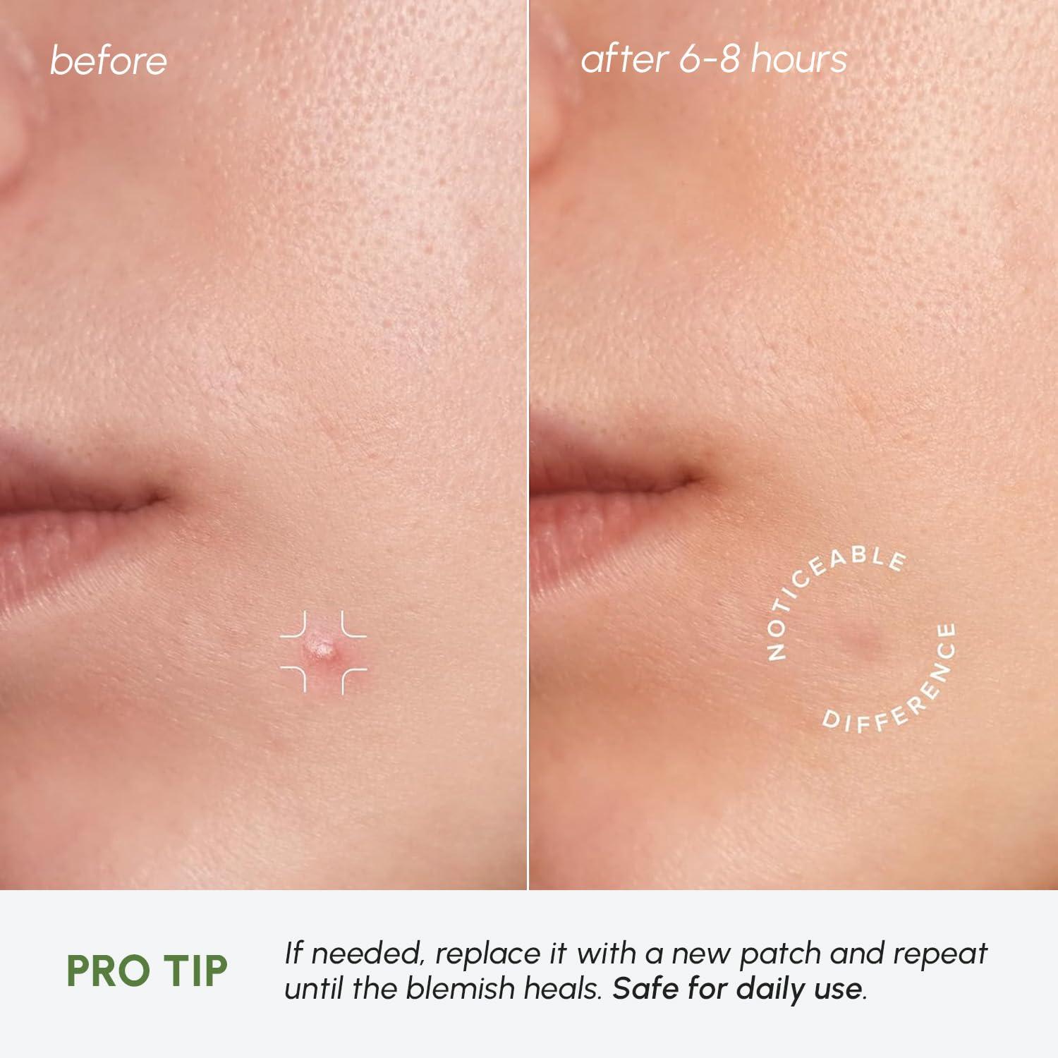 MAREE Invisible Pimple Patches – Clear Pimple Patches for Face – Hydrocolloid Acne Patches Anti Blemish – Zit Stickers for Face – Parches Para Acne – Pinple Zit Patches Pimple Stickers – 72 Dots(Clear)