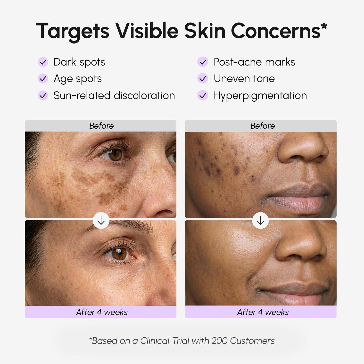 MAREE Dark Spot Remover for Face and Body – Dark Spot Corrector Serum – Hyperpigmentation, Melasma, Sun & Age Spots – Black & Brown Spot Remover for Women – Crema para Manchas Oscuras en la Cara(3.4 Fl Oz (Pack of 1))