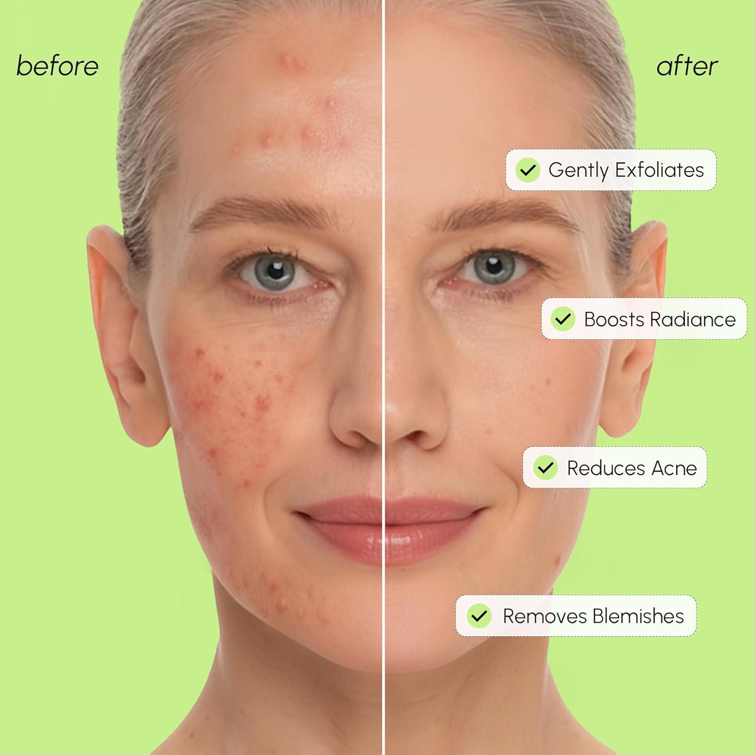 MAREE Exfoliating Toner with Salicylic Acid – AHA BHA Face Exfoliant & Pore Cleaner – BHA Liquid Exfoliant for Sebum & Dead Skin Care Remover – Face Exfoliator – Acido Salicilico Exfoliante Facial(Exfoliating)